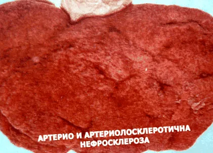 mind vezető Arterioszklerotikus nephrosclerosis