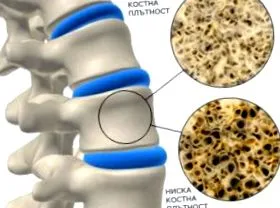 képdiagnosztikája csontritkulás