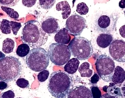 erythremia erythroleukemia erythremia