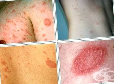 rosea lichen planus