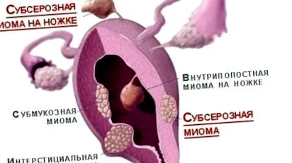mióma szuberózisos mióma