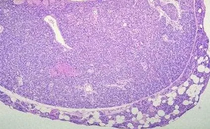 mellékpajzsmirigy adenoma mellékpajzsmirigy