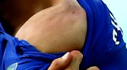 periarthritis hírek