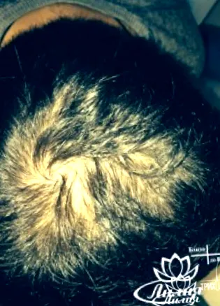 alopecia areata hajhullás