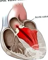 aorta reumás