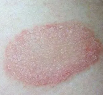 pityriasis rosacea