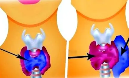 hyperthyreosis hypothyreosis