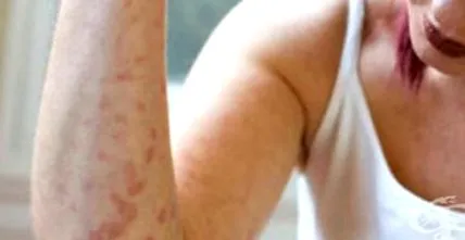 vasculitis reumás vasculitis