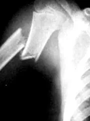 humerus