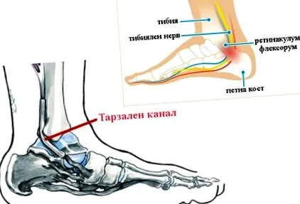 Tarsal csatorna