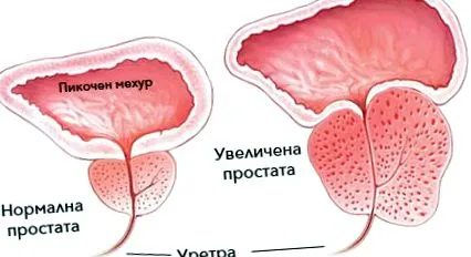 megnagyobbodott megnagyobbodott prosztata