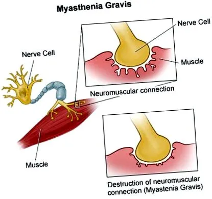 myasthenia súlyos