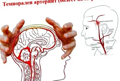 időbeli arteritis