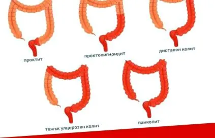 fekélyes vastagbélgyulladás