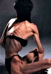 anorexiás