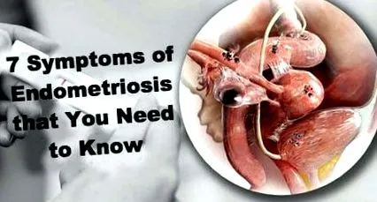 endometriózis tünete