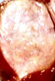 adenoma