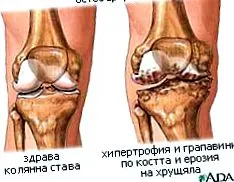 egészségügyi osteoarthritis