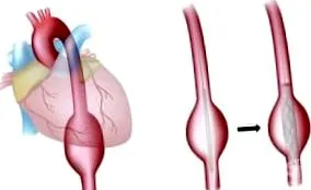 aorta hasi