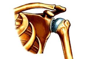 vállízület osteoarthritisje vállízület osteoarthritisje