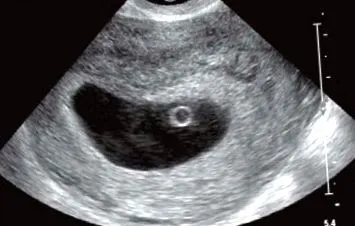 prenatális prenatális