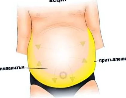 ascites ascites típusa