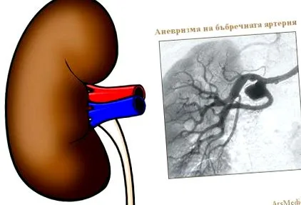 veseartéria aneurysma veseartéria aneurysma