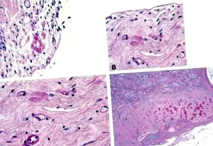 fájdalomcsillapító nephropathia