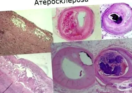 alacsony sűrűségű atherosclerosis