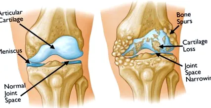 osteoarthritis vagy osteoarthritis