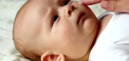 baba dermatitis