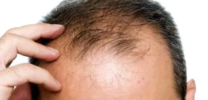 androgén alopecia