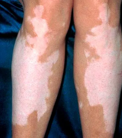 vitiligo kezelésére vitiligo kezelésére