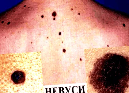 melanoma csak részét
