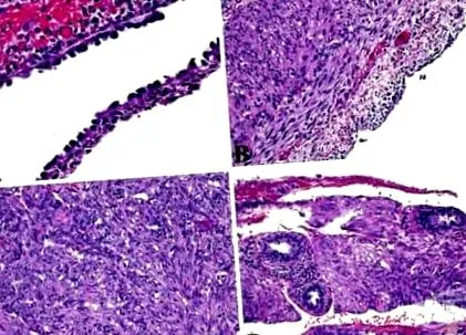 patológia vese angiomyolipoma