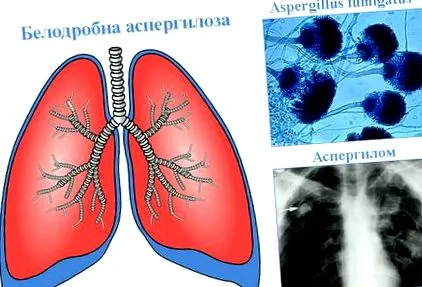 aspergilloma tünetmentes tüdő aspergillózisát