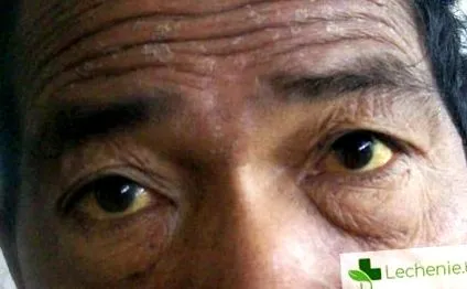 leptospirosis leptospirosis