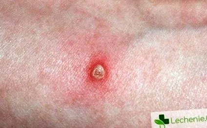 klinikai állapot Ezen mikroorganizmusok
