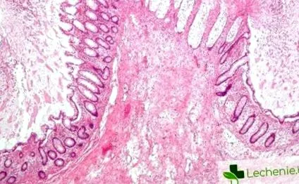 megacolon megacolon