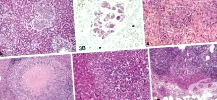 bakteriális hepatitis bakteriális