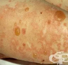 bullous dermatózisok bullous