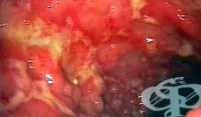 crohn-betegsége betegség előrehaladtával