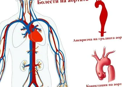aorta aorta aneurysma