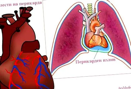 pericarditis pericarditis