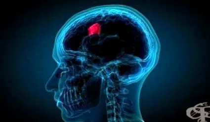 glioblastoma