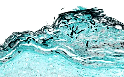 dermatomycosis mikrobiológia