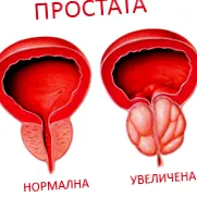 megnagyobbodott prosztata