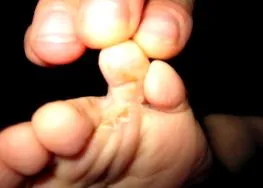 amely segít Dyshidrosis kezelés