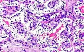 adenomatoid tumor