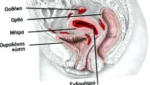 endometriózis ellátás